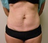 Abdominoplasty/Tummy Tuck 