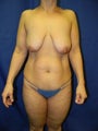 Mastopexy with augmentation.  Abdominoplasty. Liposuction.  Autologous fat transfer.