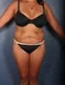 Tummy Tuck