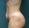 Tummy Tuck