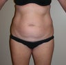 Abdominoplasty