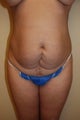 Abdominoplasty