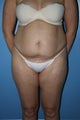 abdominopasty with suction-assisted lipectomy