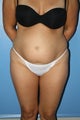 abdominoplasty with suction-assisted lipectomy