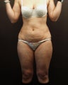 Abdominoplasty with Vaser liposuction