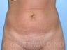 Tummy Tuck
