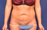 Tummy tuck