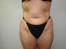 Tummy Tuck