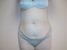 Tummy Tuck