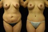 Tummy Tuck and Breast Augmentation- gel implants
