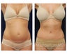 Abdominoplasty - Tummy Tuck