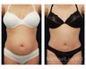 Abdominoplasty - Tummy Tuck