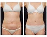 Abdominoplasty - Tummy Tuck