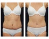 Abdominoplasty - Tummy Tuck