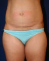 Tummy Tuck