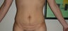 Abdominoplasty (Tummy Tuck)