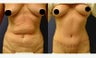 Tummy Tuck