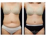 Abdominoplasty - Tummy Tuck
