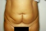 Tummy Tuck