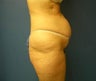 Tummy Tuck