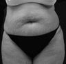 Tummy Tuck
