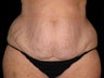 Tummy Tuck