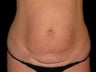Tummy Tuck