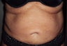 Abdominoplasty