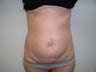 tummy tuck