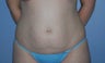 abdominoplasty and Liposuction