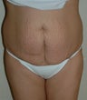 Tummy Tuck