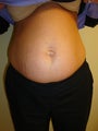 Abdominoplasty