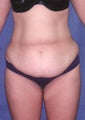 Tummy Tuck