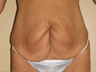 Tummy Tuck after Gastric Bypass
