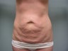 Tummy Tuck