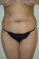 Tummy Tuck