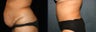 Tummy Tuck