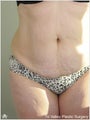 Tummy Tuck