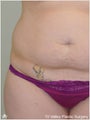 Tummy Tuck