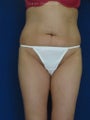 Tummy Tuck