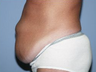 Tummy Tuck