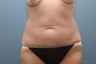 Tummy Tuck
