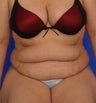 Tummy Tuck