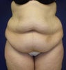 Tummy Tuck