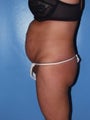 abdominoplasty with suction-assisted lipectomy