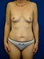 Tummy Tuck (Abdominoplasty), Breast Augmentation