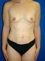 Breast Augmentation, Tummy Tuck (Abdominoplasty), Silicone gel Implants
