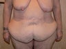 Tummy Tuck