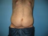 Male tummy tuck