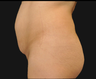 Tummy Tuck